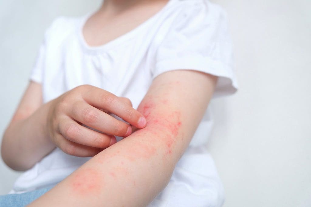 child with eczema