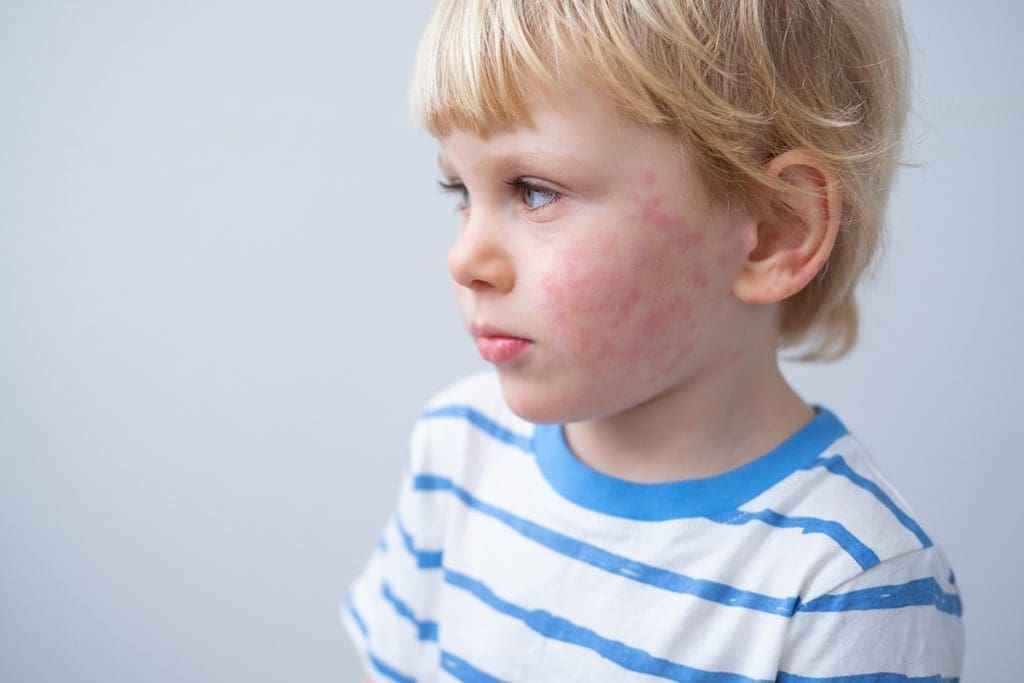 eczema allergy