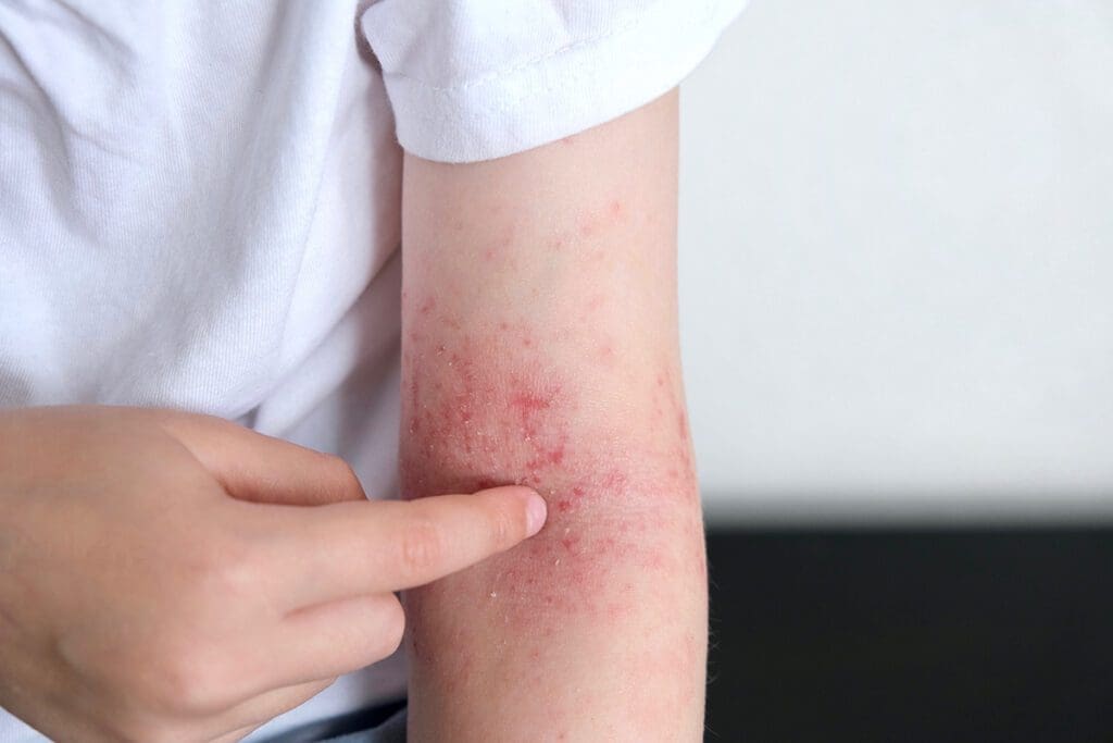 eczema